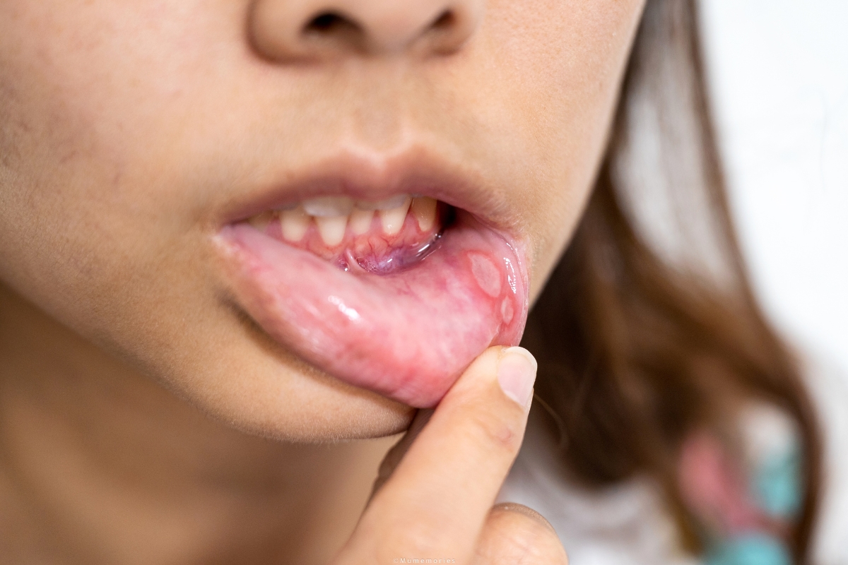 Canker Sore vs. Cold Sore