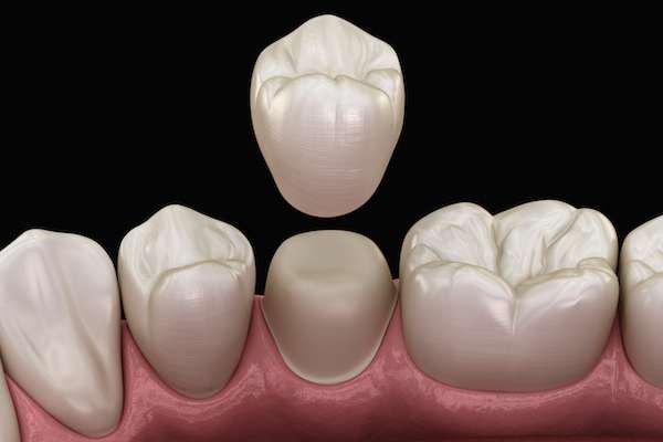 What To Ask Your General Dentist When Preparing for a Crown from West Albany Dental in Albany, OR