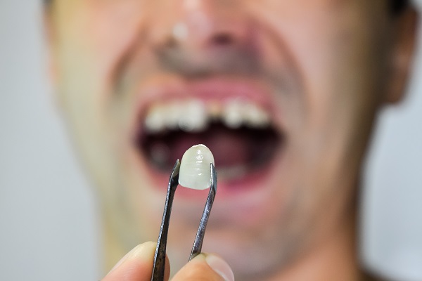 Repair Options For A Broken Tooth