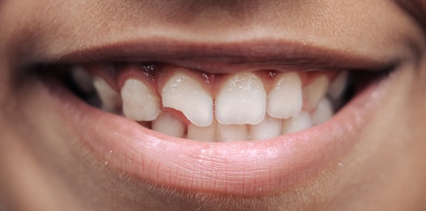 When Is A Broken Tooth A Dental  Emergency?