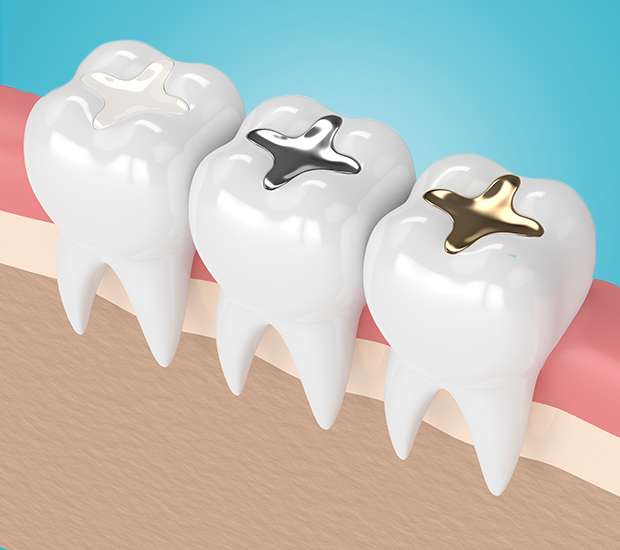 Albany Composite Fillings