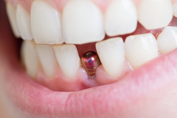 Dental Implants Albany, OR