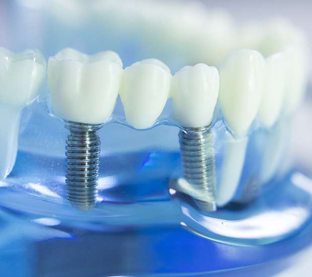 Albany Dental Implants